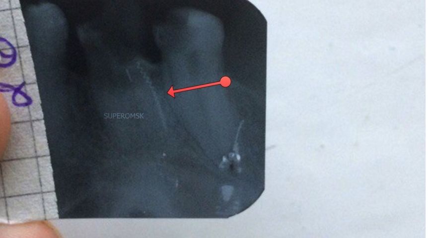 В Омске стоматолог забыл в челюсти пациента кусок сверла